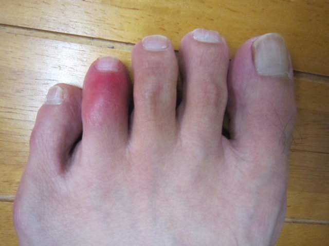 足の指を打撲してしまいました 名古屋市緑区 はり 灸 マッサージ 指圧 ライフ治療院