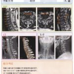 最新  頚椎症の手術前後のCTとMRIの詳細へ